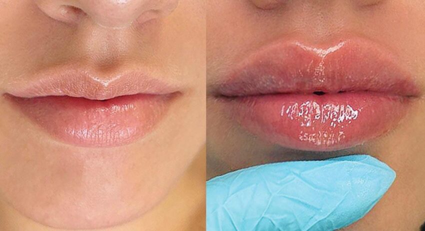 Russian Lips, procedura-vedetă de volumizare a buzelor